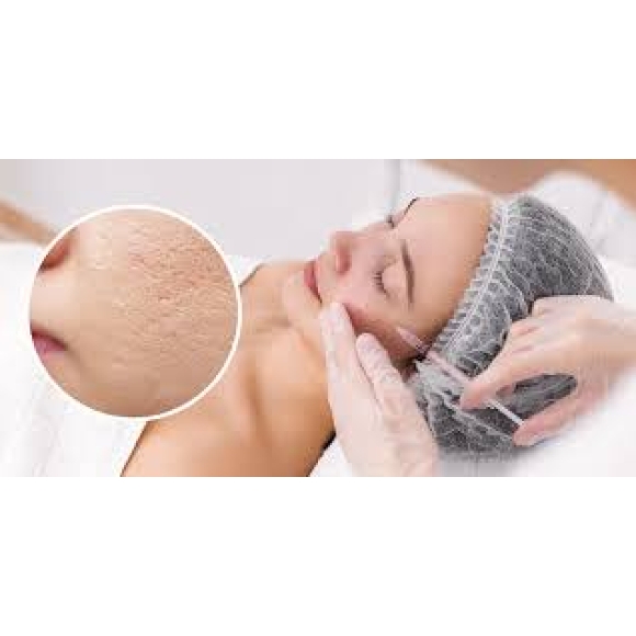 Meso điều trị sẹo lỗ