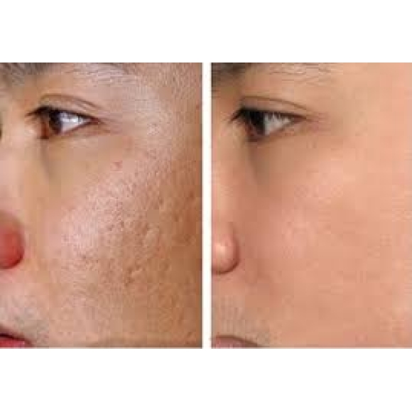 Điều trị sẹo rỗ