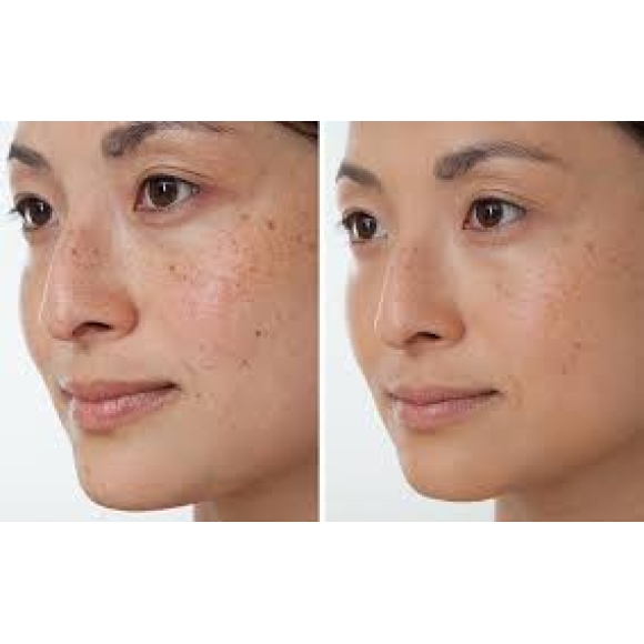 Điều trị tàn nhang